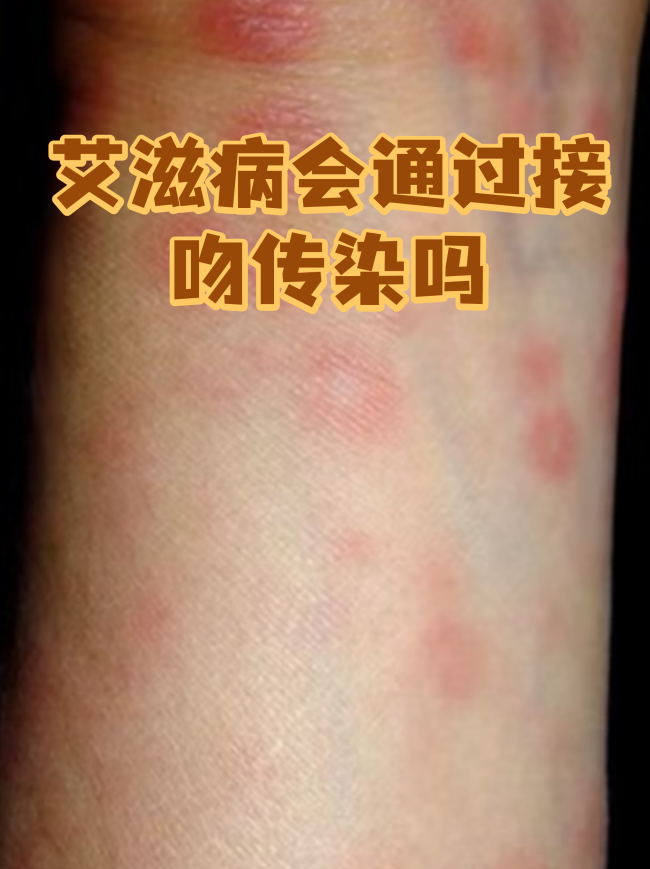接吻会传播艾滋病吗?