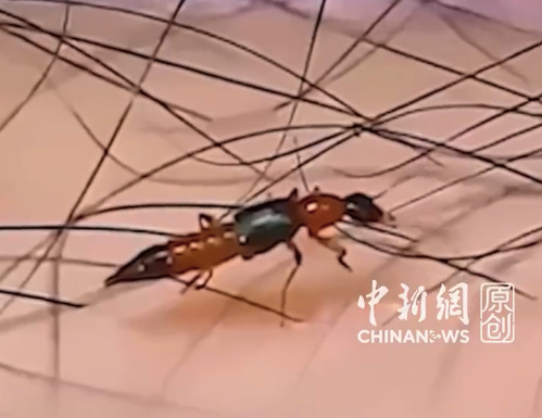 毒隐翅虫外观是黑黄两色尾巴尖尖 专家称隐翅虫只有一个属有毒