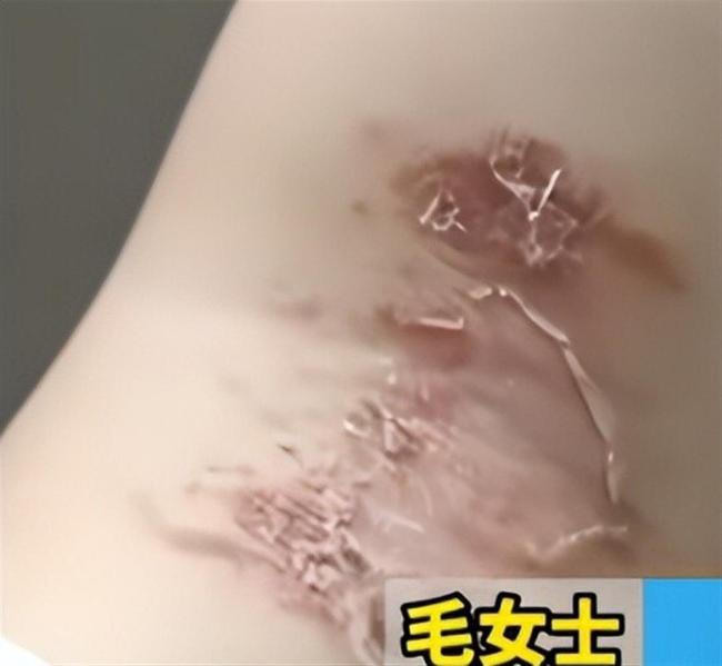 女子徒手掐隐翅虫玩结果中招了 隐翅虫毒液堪比“飞行硫酸”