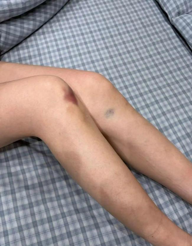 女孩确诊小脑萎缩决定死后捐献器官 爱心传递希望