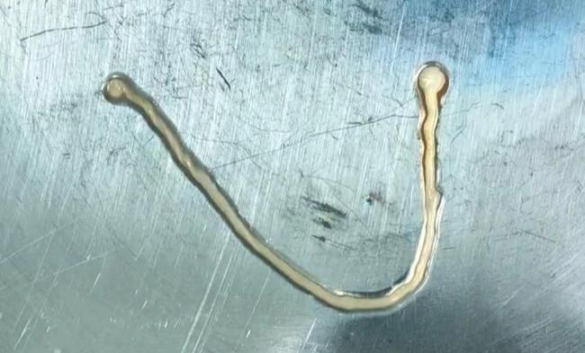 男子颅内3毫米病灶取出伸展为10厘米活虫 罕见裂头蚴病例揭秘