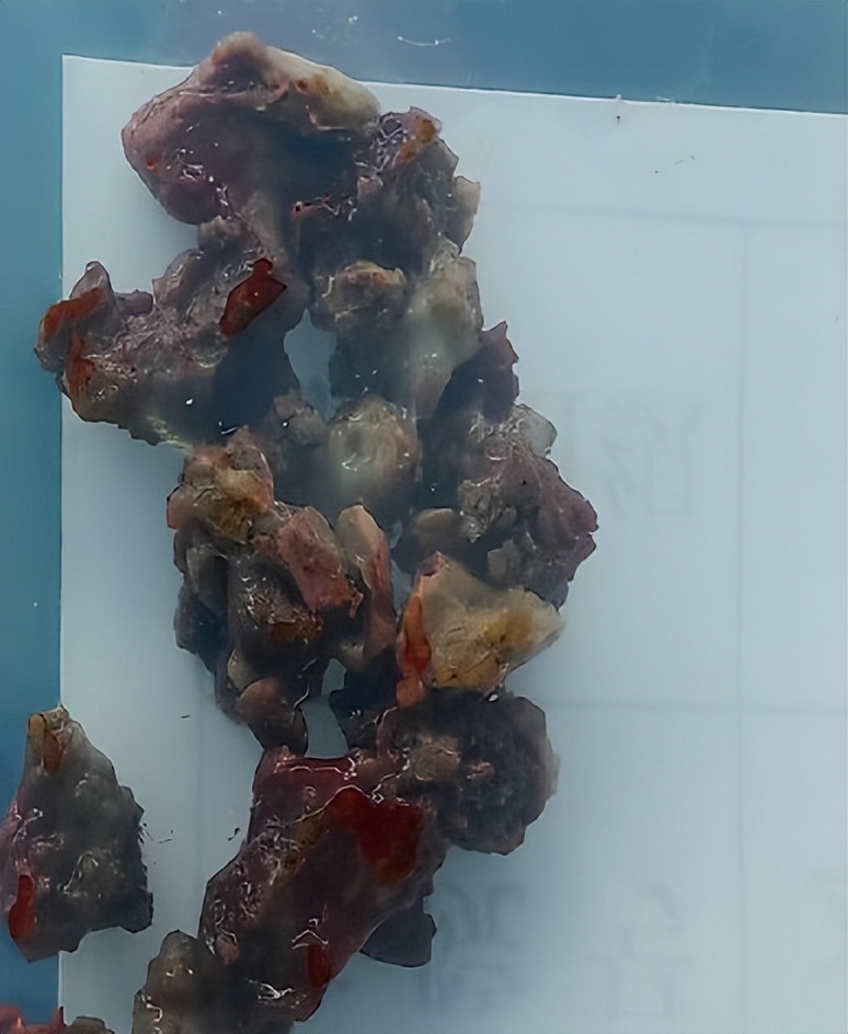 女子鼻整形十年后,钛钉“游走”致面部胀痛