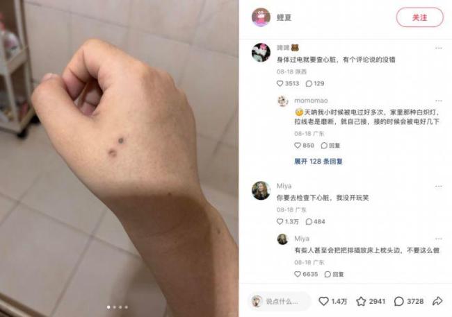 睡觉时充电线贴皮肤醒来三度烧伤 低压不等于绝对安全