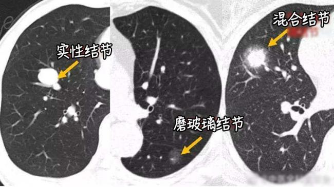 钟南山团队:超7成肺癌病例不吸烟无粉尘暴露 非高危人群需警惕
