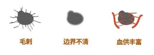 钟南山团队:超7成肺癌病例不吸烟无粉尘暴露 非高危人群需警惕
