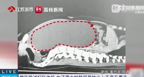 女子腹大如鼓抽出7000毫升囊液 常年跳过妇科体检突现卵巢瘤