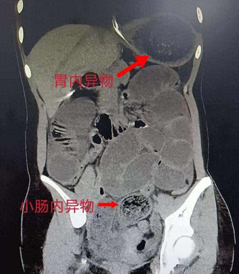 13岁女孩从肠胃中取出6盆头发团!和孩子多年异常行为有关