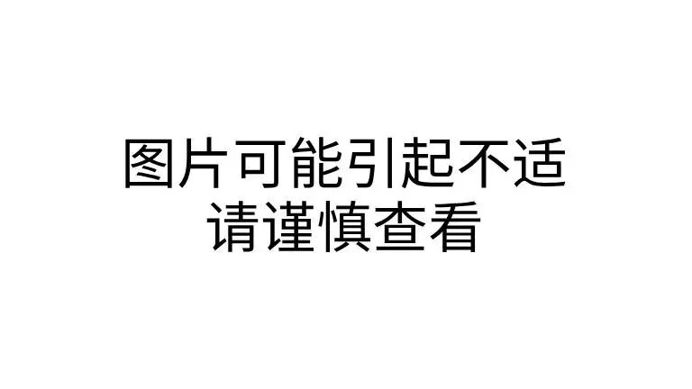 13岁女孩从肠胃中取出6盆头发团!和孩子多年异常行为有关