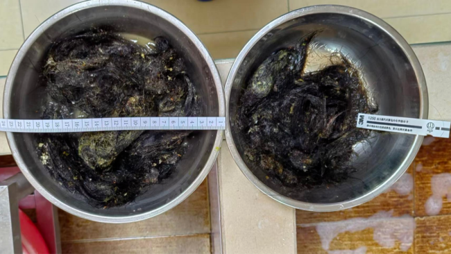 13岁女孩吞食头发致肠梗阻 异食症引发多并发症
