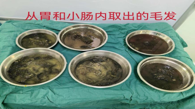 13岁女孩吞食头发致肠梗阻 异食症引发多并发症