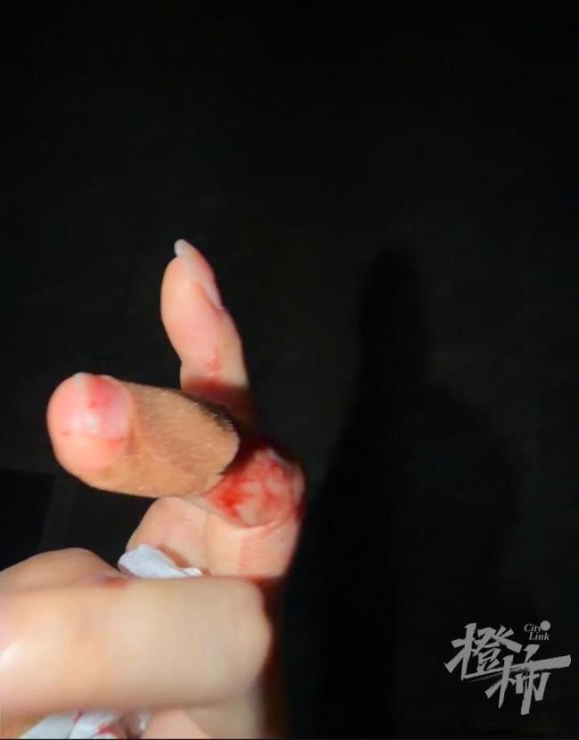 女子被手机钢化膜扎伤切了一块肉