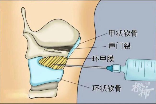 男子喝了几口隔夜鱼汤差点窒息 几口汤引发生死危机