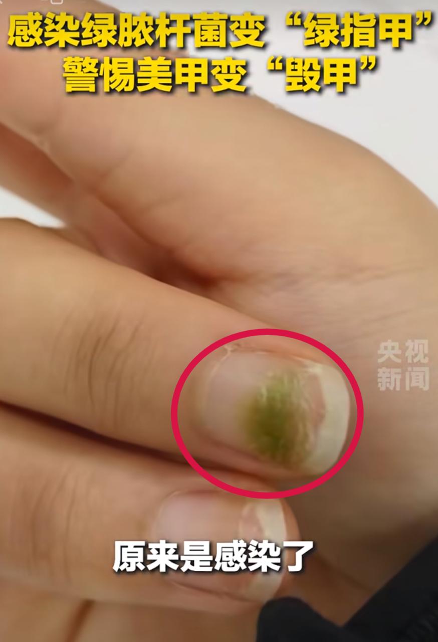 女子做超长美甲睡觉翻身连根折断 欧气爆棚传说奖