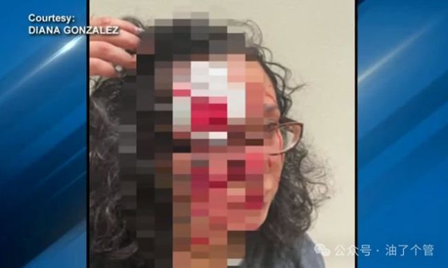 美国女子街头遭陌生人啃脸 仇恨犯罪引发关注