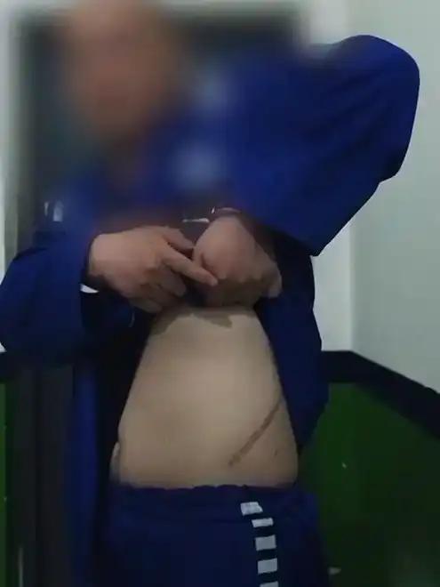 缅北电诈回流人员自述被割肾经历