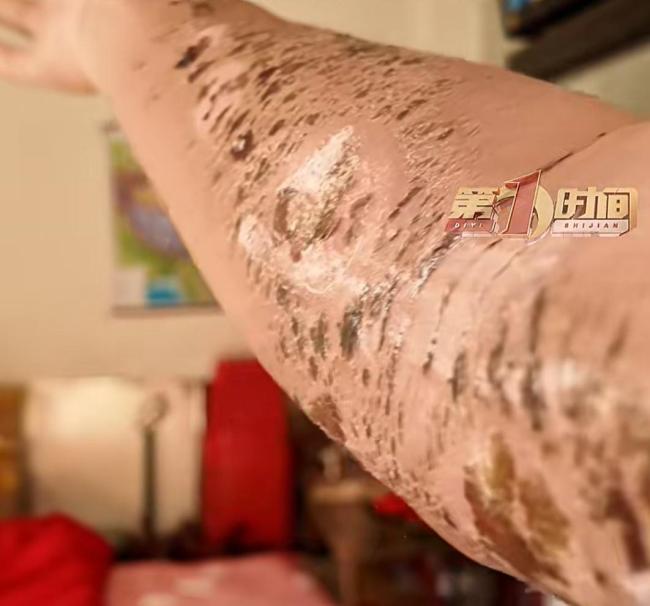 小伙下地割草遭毒蛇咬伤手臂