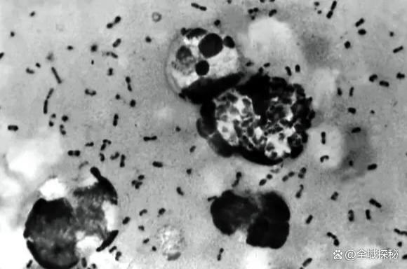 俄罗斯女研究员打碎鼠疫杆菌试管，7天后因不明肺炎死亡 引发全球关注