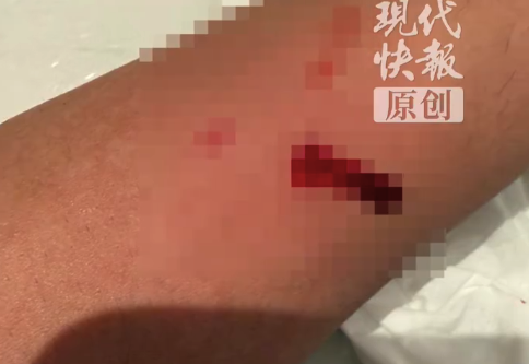 男子称住知名酒店睡觉时被老鼠咬伤 酒店回应