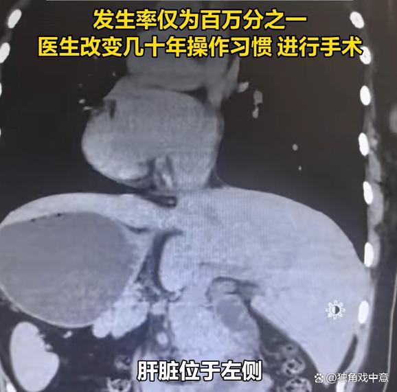女生五脏六腑全长反 罕见“镜面人”成功换心