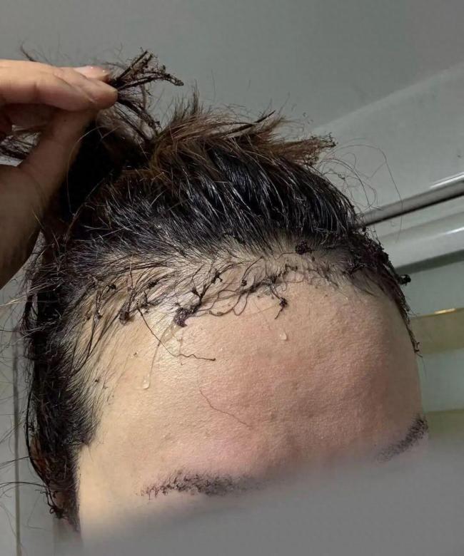 女子用定妆喷雾后点火突发火球扑脸