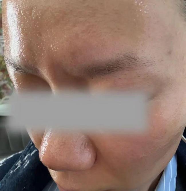 女子用定妆喷雾后点火突发火球扑脸 粉扑残留引发爆燃