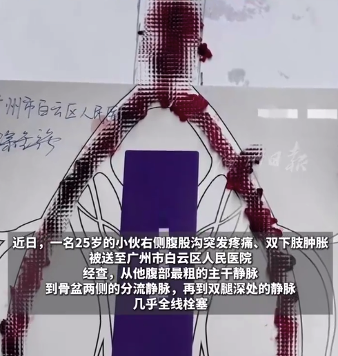 25岁小伙腹部到腿部的血管几乎堵死 医生手术取出大量血栓目前恢复良好
