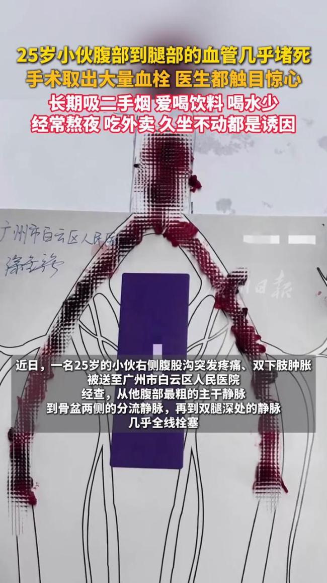 男子腹腿血管堵死手术取出大量血栓
