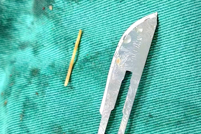 4厘米鱼刺体内漂流20天穿肠而出 腹痛忽视险酿大祸