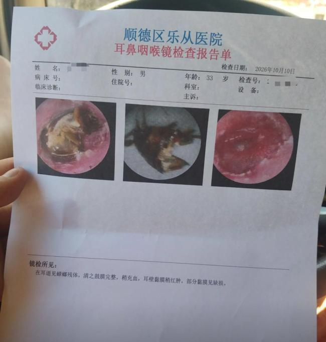 男子睡梦中蟑螂钻进耳道 耳膜险穿孔