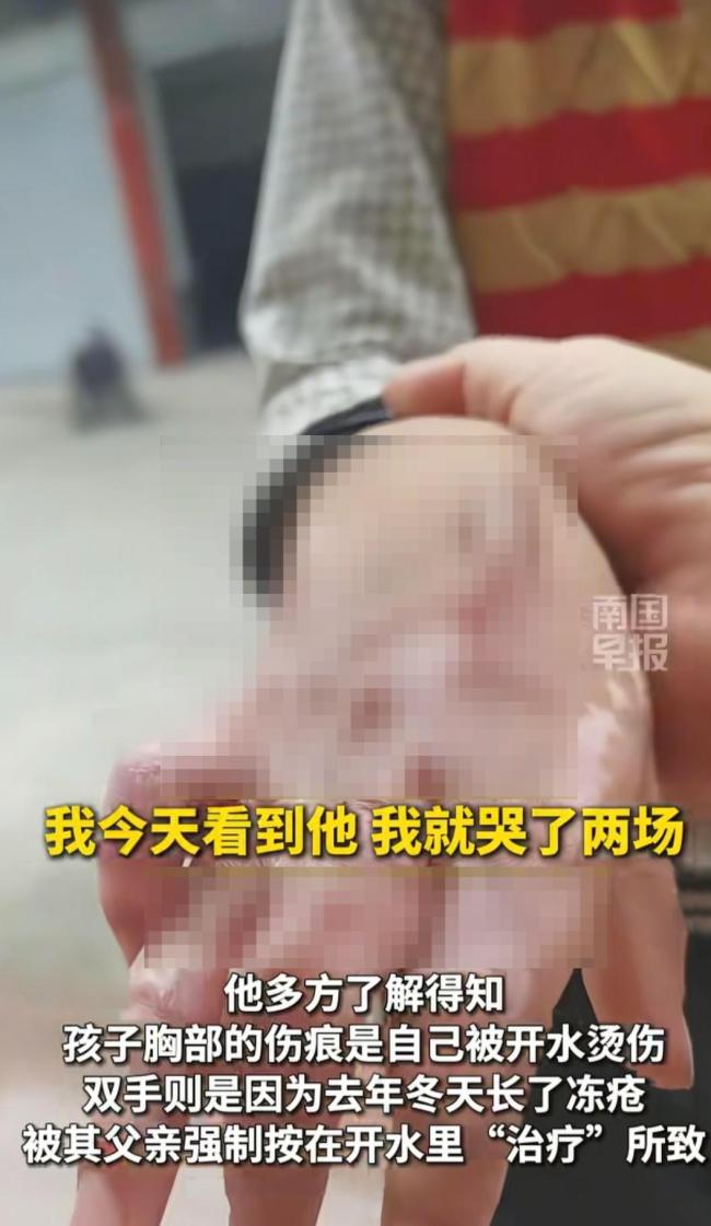 四川9岁男孩伤疤系意外所致 网友担忧引发关注