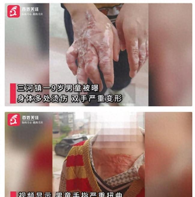 男童被曝双手严重变形、胸口留疤
