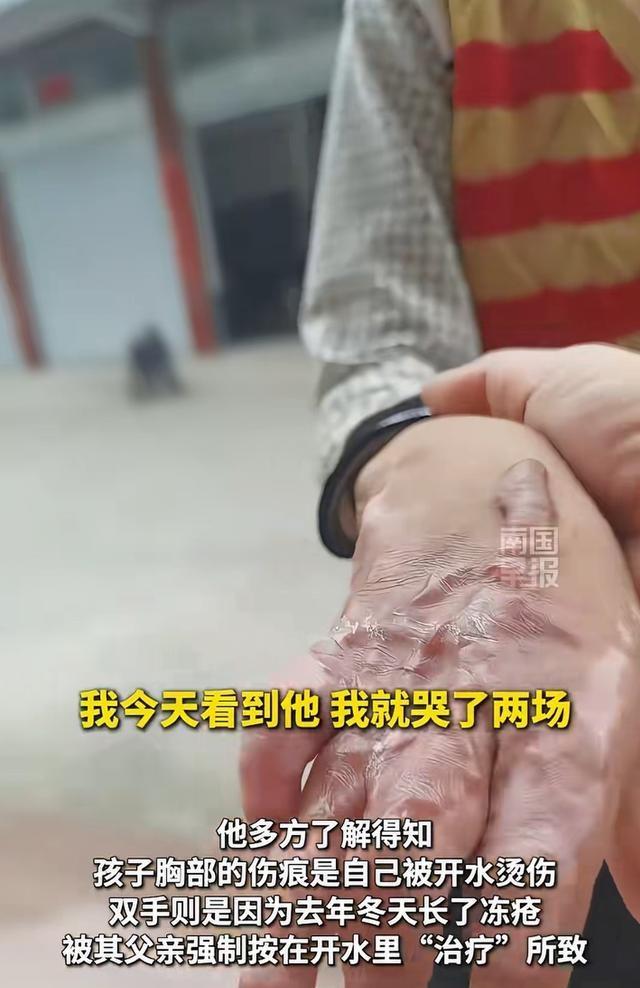 多部门介入9岁男孩全身多处烫伤疤