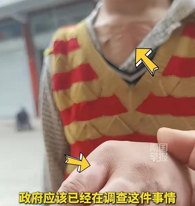 多部门介入9岁男孩全身多处烫伤疤 揭开伤痕背后的真相